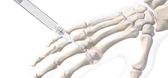 The unique molecule at the heart of our products  Hyaluronic acid is a naturally occurring substance that is found throughout the human body, with the highest concentrations found in the joints, skin, tendons, and eyes. It is a glycosaminoglycan, a type of molecule composed of sugars, that plays a vital role in maintaining the structural integrity and hydration of tissues.  Hyaluronic acid’s hydrating properties are attributed to its ability to strongly bind to water. Another notable property of hyaluronic acid is its excellent viscoelasticity — a combination of elastic and viscous behaviour.   These hydrating and viscoelastic properties make it useful for a range of functions across different tissues in the human body. In the skin, it helps to keep the skin firm, hydrated and elastic. In the eyes, it helps to maintain the gel-like consistency of the vitreous humour by stabilising the collagen network and retaining water; its viscoelasticity in the vitreous acts to absorb shocks, protecting the retina and the lens.1 In the joints, it acts as a shock absorber and a lubricant to support smooth joint movement.    Hyaluronic acid applications  Because of its unique properties, hyaluronic acid is commonly used in both aesthetic and medical applications, including rheumatology, ophthalmology, and dermatology. For these uses, the sodium salt form of hyaluronic acid — sodium hyaluronate — is typically used. Both molecules share similar properties, however, sodium hyaluronate is preferred for use in medical applications due to its high solubility in water and physiological pH. Sometimes the terms hyaluronic acid and sodium hyaluronate may be used interchangeably.  In rheumatology, sodium hyaluronate has multiple applications. It is an effective treatment for relieving joint pain caused by osteoarthritis. Its use can improve joint function2,3 and prolong the time before patients require joint surgery.4 It is also used to aid tissue repair in tendinopathies — speeding up the recovery process5 and reducing tendon pain.6 Sodium hyaluronate can also be used to replace the synovial fluid in the joint following joint surgery, aiding post-surgery recovery.7,8   In ophthalmology, sodium hyaluronate is an effective treatment for dry eye syndrome.9 It acts to soothe dry eyes and reduce the symptoms of dryness, itchiness, and burning sensation.10 In ophthalmic surgeries such as cataract and glaucoma surgery, a more concentrated sodium hyaluronate solution with gel-like properties is used as an adjuvant. It is commonly injected into the anterior chamber of the eye during surgery to maintain good visibility, facilitate the insertion of surgical instruments, and protect delicate tissues from damage.11 Its application on the surface of the eye also helps to maintain corneal hydration, preventing dryness and reducing the risk of damage to the cornea.12   In dermatology and aesthetic medicine, sodium hyaluronate is often used as a dermal filler to reduce the appearance of fine lines and wrinkles and to increase skin hydration. Aesthetic injections can also be performed in deeper layers, as a large volume filling device, such as to restore firmness and volume to the face and lips.13    TRB Chemedica: pioneers in the development of hyaluronic-acid treatments  Founded in 1980, TRB Chemedica has been focused on innovating and developing medical products of the highest quality since its inception. TRB Chemedica was among the first to develop pharmaceutical-grade sodium hyaluronate formulations from non-animal origin, using biofermented hyaluronic acid. In 1998, TRB Chemedica set a new standard in the treatment of osteoarthritis by introducing OSTENIL®, our sodium hyaluronate solution for intra-articular use. With a quarter-century of expertise, we have an extensive track record of in-house development of sodium hyaluronate products that are both safe and effective.    Producing hyaluronic acid products with Swiss precision and safety   TRB Chemedica's industrial site in Vouvry, Valais, Switzerland, is a Swissmedic-certified and GMP-qualified manufacturing facility. On-site, the hyaluronic acid product manufacturing unit is paired closely with the R&D division. This enables innovative production methods and ensures that TRB Chemedica remains at the forefront of the highest manufacturing standards. By maintaining autonomy over the entire R&D and production process, we can ensure the utmost level of quality of our products.  Maintaining a high level of manufacturing standards is essential to delivering sodium hyaluronate products with an excellent safety profile and tolerability. At TRB Chemedica, our sodium hyaluronate products are developed using biofermented hyaluronic acid, meaning that our products are not derived from animals. Thanks to a high degree of biocompatibility with human tissues, our sodium hyaluronate has a superior safety and tolerability profile compared with competitor products derived from chemically cross-linked animal hyaluronic acid.14–16 In the context of our rheumatology products, this means there is minimal likelihood of post-injection reactions such as localised pain, swelling, or allergic reactions.